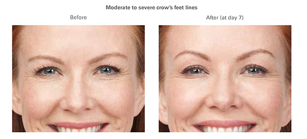 CROWS FEET Before & After Photos